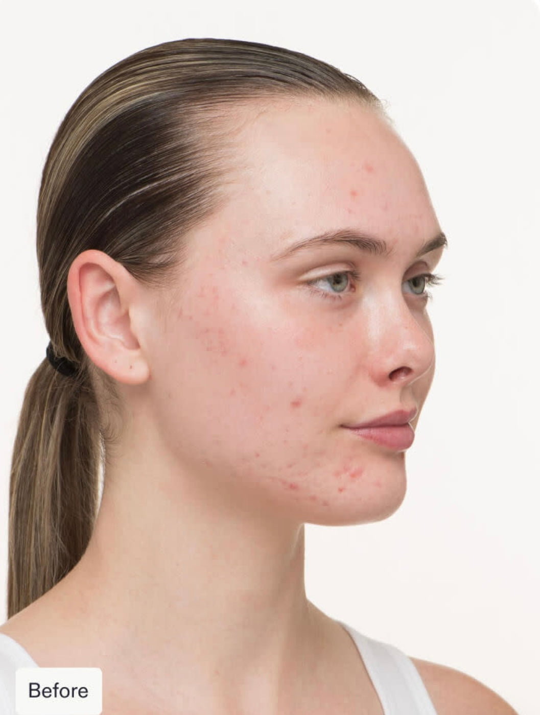 Nutrafol Clear Skin Nutraceutical - 3 Month Supply